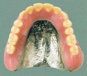 総入れ歯金属床
