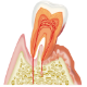 歯周病